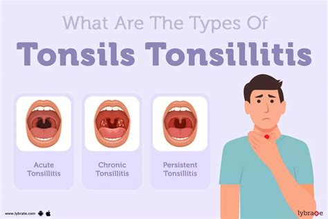 Tonsillitis .